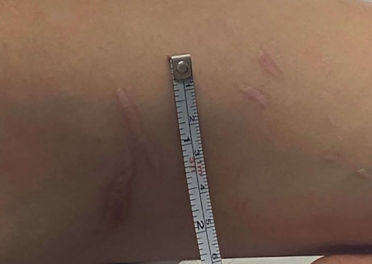 Ärr som mannen, enligt åtalet, fått i samband med misshandeln från kvinnan. Foto: Polisens förundersökning