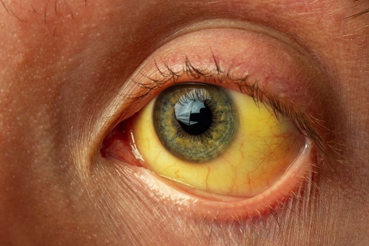 Hepatit C är svårt att upptäcka och när symtom visar sig har leverskada hunnit uppstå. Ett tecken är gulsot, vilket bland annat ger gultonade ögonvitor. Foto: Dreamstime